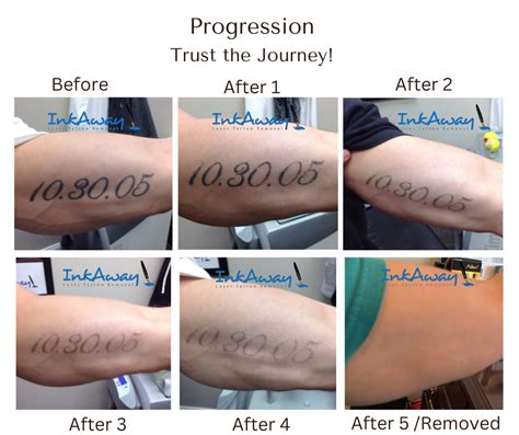 nude tattoo removal|laser tattoo removal progress.